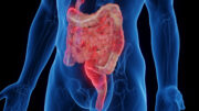 Morbus Crohn: Ein experimentelles Modell ahmt typische Fettansammlung nach und erleichtert deren Erforschung