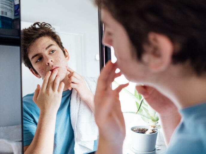 Jugendlicher mit Akne