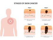 Makrophagen steigern Aggressivität von Melanomzellen