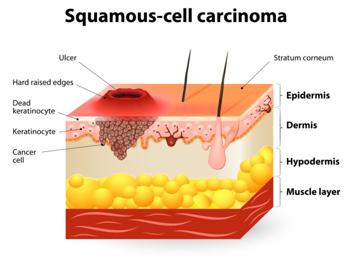 Kutanes Plattenepithelkarzinom