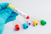 BvDU wendet sich gegen PSA-Heimtests