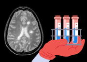 Neue diagnostische Marker für Multiple Sklerose