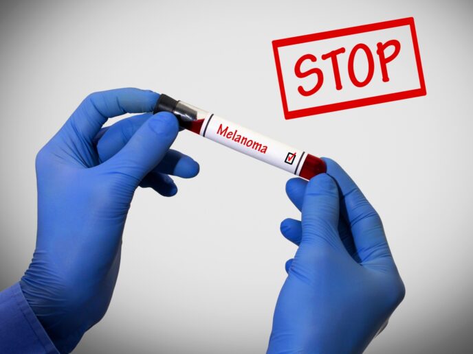 Melanom