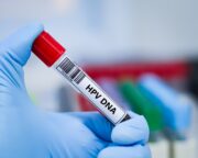 Risikobewertung bei HPV-bedingtem Oropharynxkarzinom