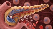 Hohes Diabetesrisiko trotz langfristigem Gewichtsverlust?