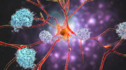 DGN kritisiert Übersichtsarbeit zu neuen Alzheimer-Medikamenten