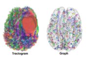 Glioblastome beeinflussen das Gehirn stärker als gedacht