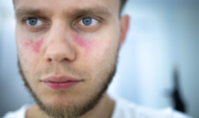 Systemischer Lupus Erythematodes: Krankheitskontrolle und langfristige Perspektiven auf Heilung