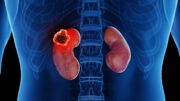 Behandlung des metastasierten Nierenzellkarzinoms: Neubewertung der Rolle der zytoreduktiven Nephrektomie gefordert