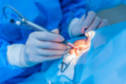 Weiße Katarakt: Eight-Chop-Technik zeigt sichere und effiziente Phakoemulsifikation