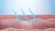 UV-Therapie und Photochemotherapie: Aktualisierte Leitlinie veröffentlicht