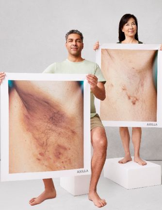 Hidradenitis suppurativa Awareness Week
