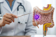 Darmkrebs: Schlüsselprotein für Chemotherapie-Resistenz identifiziert