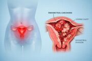 Endometrioides Endometriumkarzinom: Biomarker könnte Erfolg fertilitätserhaltender Progesterontherapie vorhersagen