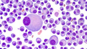 Multiples Myelom: Seltene Nebenwirkung von CAR-T-Zellen erfordert interdisziplinäre Versorgung