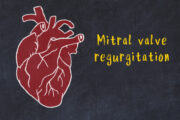 Studie schafft Grundlage für einheitliche Definition der atrialen funktionellen Mitralklappeninsuffizienz