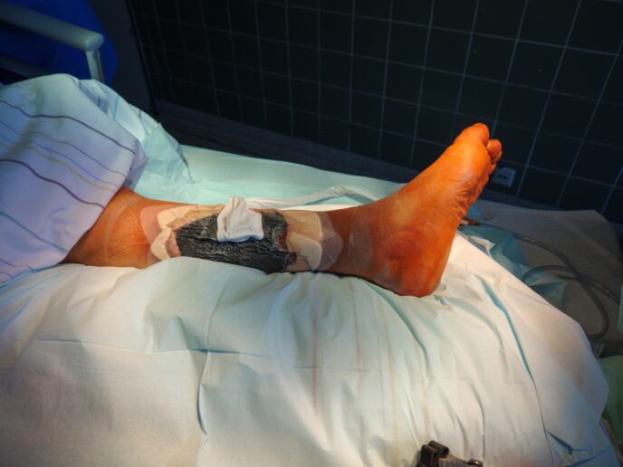 Wundtherapie mit Unterdruck