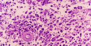 Digitale Pathologie: KI beschleunigt Diagnostik von Hirntumoren