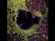 Überraschend normale Umgebung: Von intraepithelialen Neoplasien zum Pankreaskarzinom