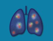 Neuer therapeutischer Ansatz: Stoffwechsel-Schalter gegen Lungenkrebs