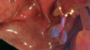 Hypothalamische Adipositas: Setmelanotid reduziert BMI nach Hirntumoren signifikant