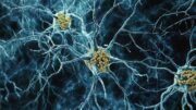 Anti-Tau-Therapie verfehlt klinischen Endpunkt – greift die Alzheimer-Therapie zu spät?
