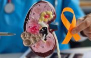 Klarzelliges Nierenzellkarzinom: IL8-positive-tumorassoziierte Makrophagen fördern die Immuntherapie-Resistenz