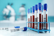 Neuer Bluttest für Endometriose basierend auf hormonellen Unterschieden
