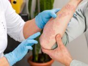 Psoriasis: Topische Ansätze zielen direkt auf Keratinozyten-Signalwege