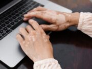 Vitiligo: Können Melanozyten reaktiviert werden?