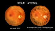 Retinitis pigmentosa: Ein-Jahres-Überleben von aus Stammzellen gewonnenen neuralen Vorläuferzellen gezeigt