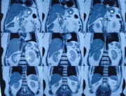 Nierentumor-OP: Präoperative mpMRT unterstützt die Vorhersage der Nierenfunktion nach Nephrektomie