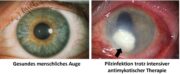 Pilzkeratitis: Wenn Pilze das Auge bedrohen