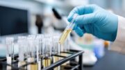Urin-Biomarker könnten nicht invasive Diagnose des Nierenzellkarzinoms ermöglichen