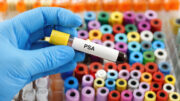 Metastasierter Prostatakrebs: PSA unter 0,2 zeigt Therapieerfolg an