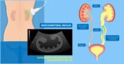 Vesikorenaler Reflux: Durchbruch-Harnwegsinfektionen vorhersagen