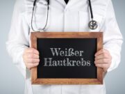Immunzelldysfunktion bei nicht melanozytärem Hautkrebs