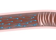 Obstruktive Azoospermie: Gute Erfolge mit longitudinaler Intussuszeptions-Vasoepididymostomie