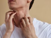 Ekzem und Allergien: Dendritische Zellen treiben Immunglobulin-E-Antwort voran