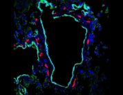 Lungenmetastasen: Von Primärtumoren produziertes Protein begünstigt die Entstehung