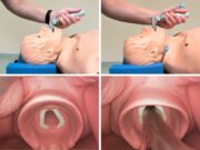Bessere Sicht, mehr Sicherheit im OP: Videolaryngoskopie überzeugt im Vergleich